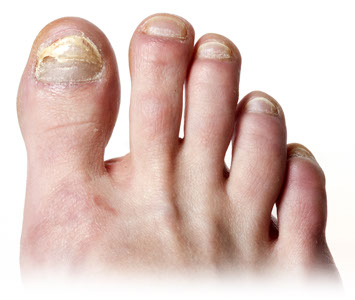 toe nail fungus